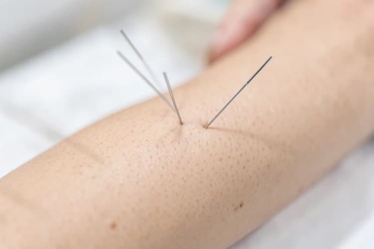 Pessoa recebendo acupuntura no braço